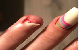 What to do when a false nail is ripped out?