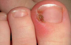 Most common nail problems:causes and treatments