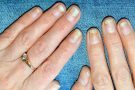 What is nail psoriasis?