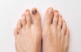 Medical treatments for black toenails