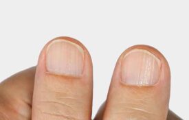 Solutions for striped nails