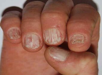 Diseased nails: The best tips for treating them
